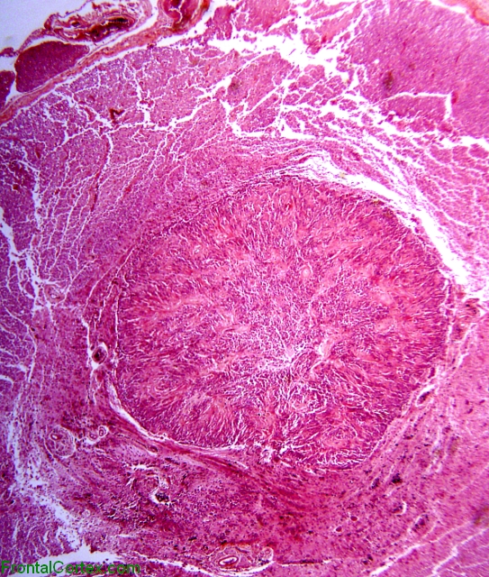 Intramedullary spinal cord ependymoma, H&E stain x20